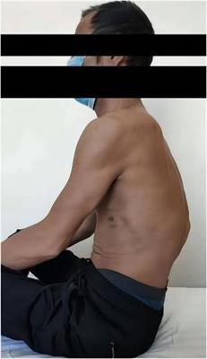 Posterior hemivertebra resection and reconstruction for the correction of old AO type B2.3 thoracic fracture kyphosis: A case report